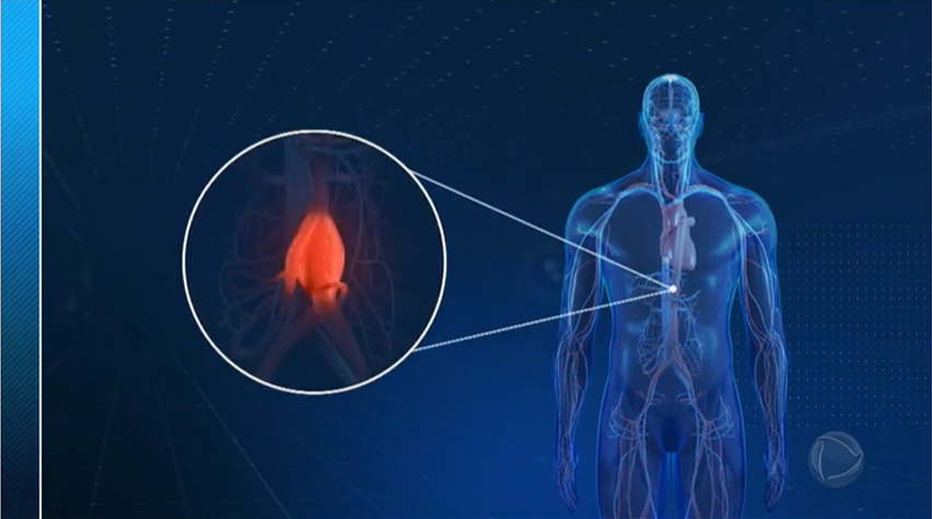 Tabagismo é o principal fator de risco para casos de aneurisma da aorta, revela pesquisa