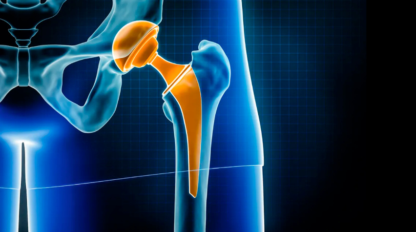Prótese de quadril: quando é indicada e como é a volta aos treinos?
