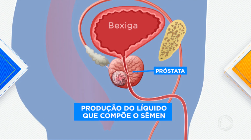 Preconceito ainda é barreira na prevenção ao câncer de próstata