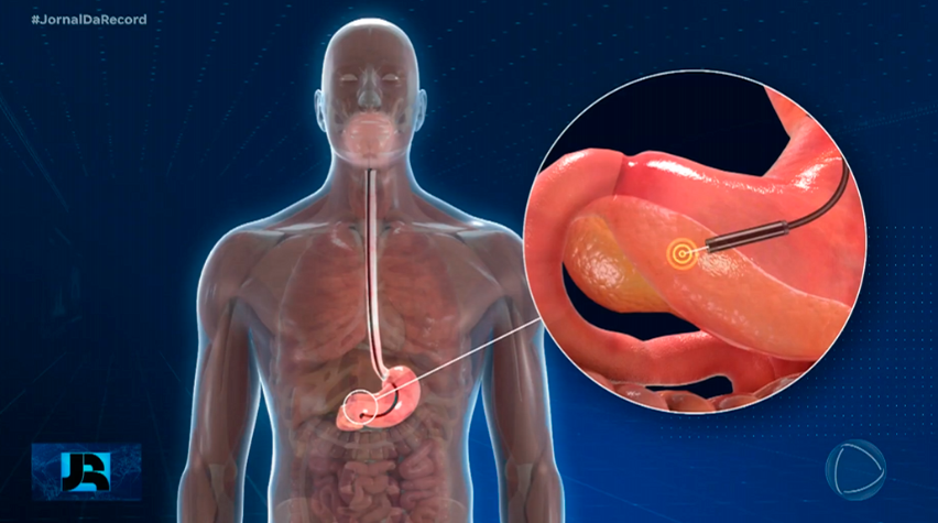 Uso de radiofrequência revoluciona o tratamento de pacientes com câncer de pâncreas